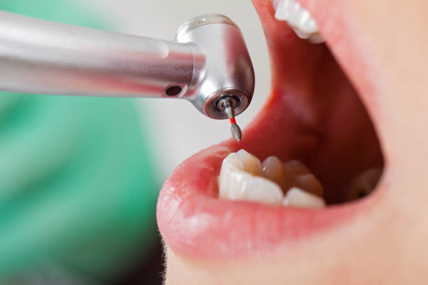 Best Emergency Treatment for Dental Infections or Abscesses in Bull Run, VA